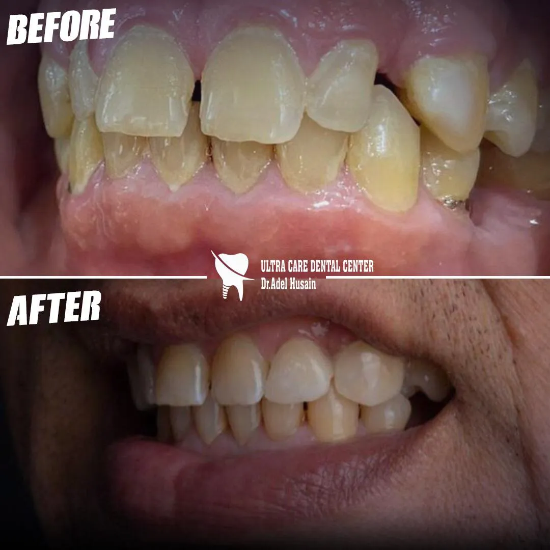 فينيرز ولومينيرز